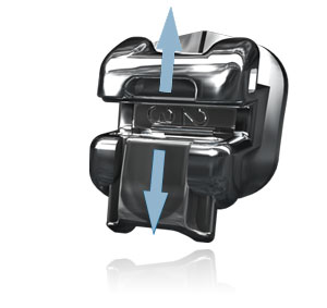 Advanced Metal Braces