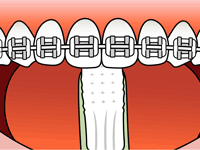 Brushing Step 3