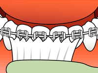 Brushing Step 4