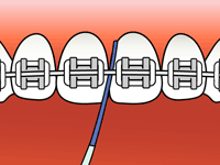 Flossing Step 1