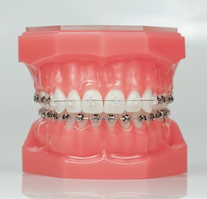 Damon Braces Model