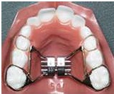 Rapid Maxillary Expander
