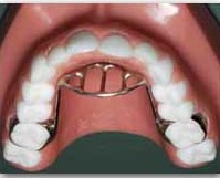 Tongue Thrusting Appliance